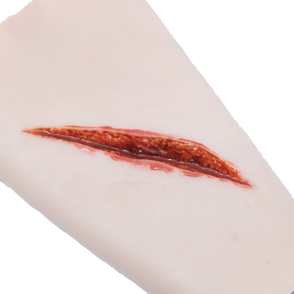 Sharp Laceration Forearm with Bleeding Capacity